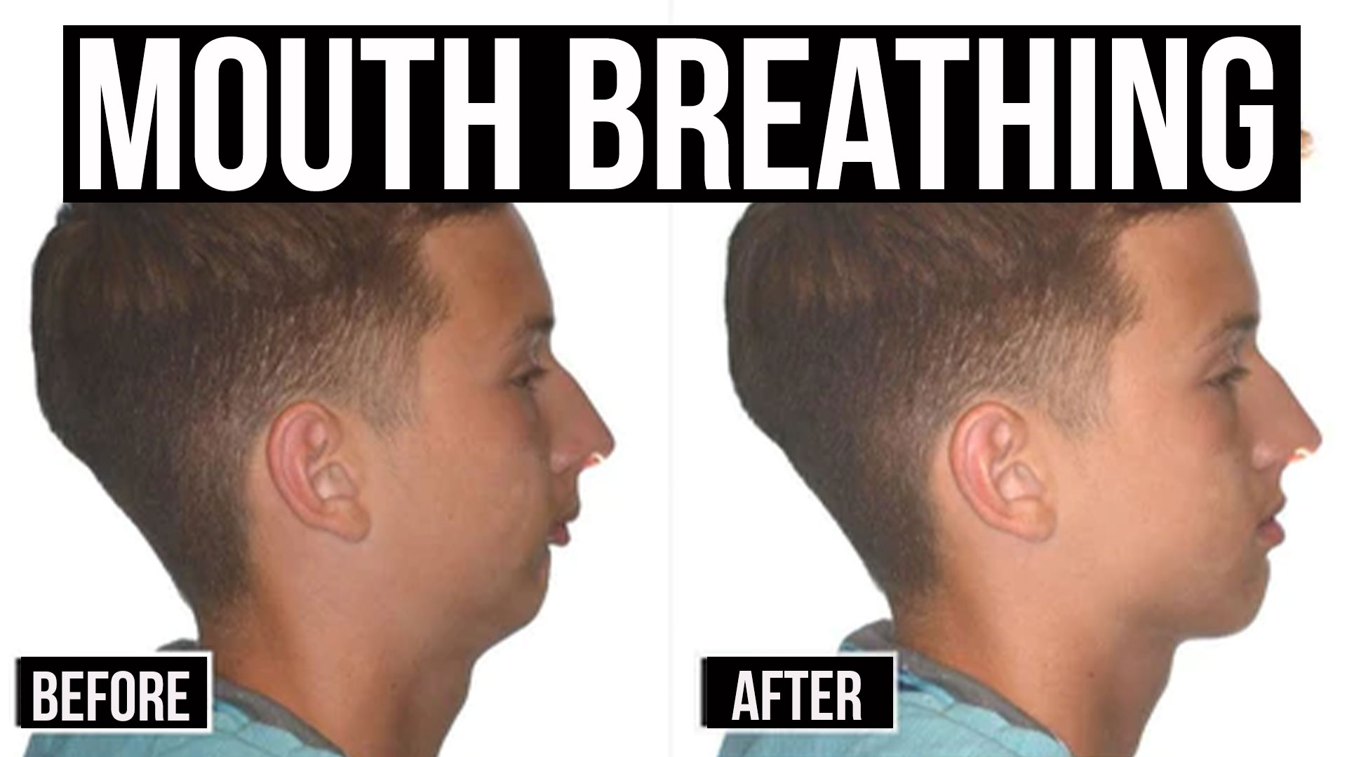 Fix Your Tongue Posture And Mouth Breathing For Better Sleep More 